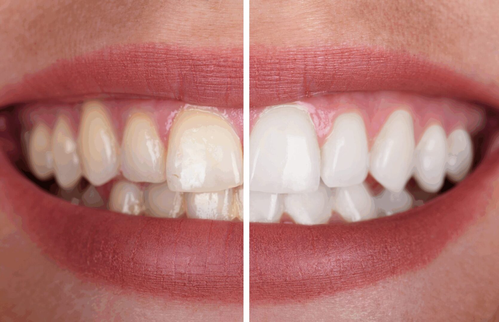 Before after image of woman with a perfect wwhite teeth after undergoing teeth whitening in Prestige Dental Spa in Lake Elsinore