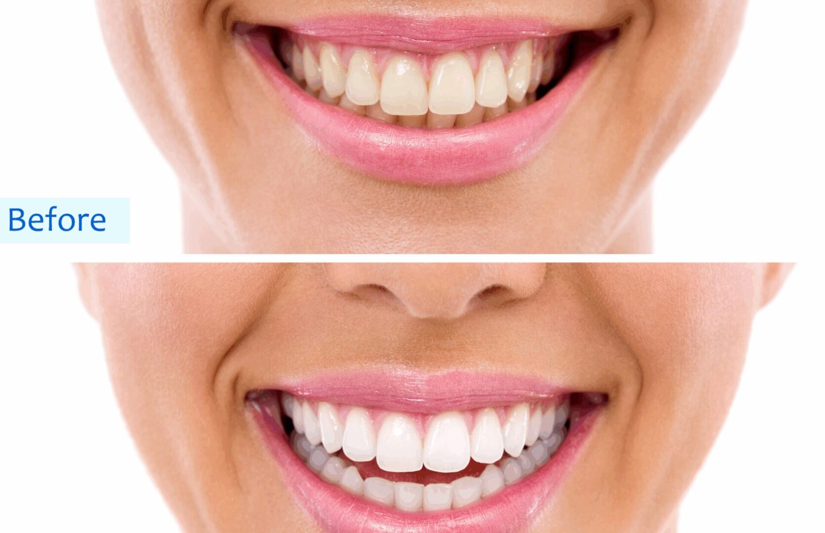Before after image of woman teeth after undergoing teeth whitening in Prestige Dental Spa in Lake Elsinore