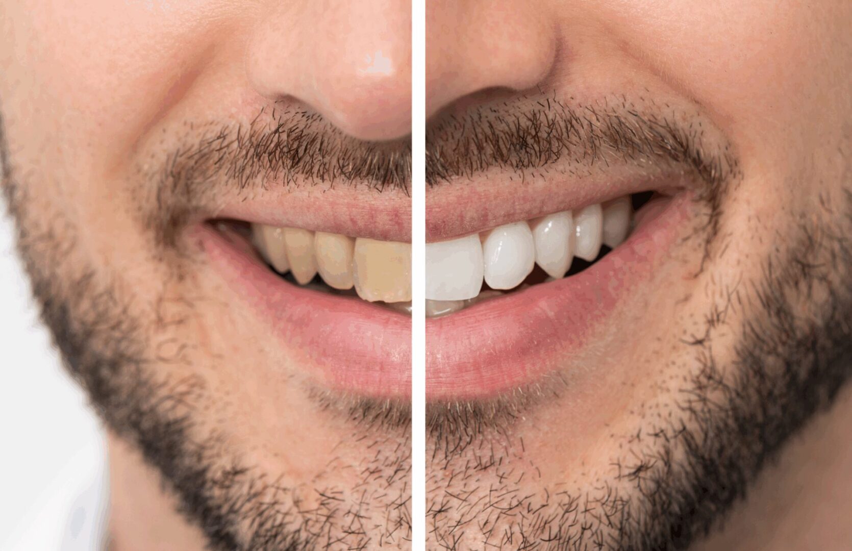 Before after image of man teeth after undergoing teeth whitening in Prestige Dental Spa in Lake Elsinore