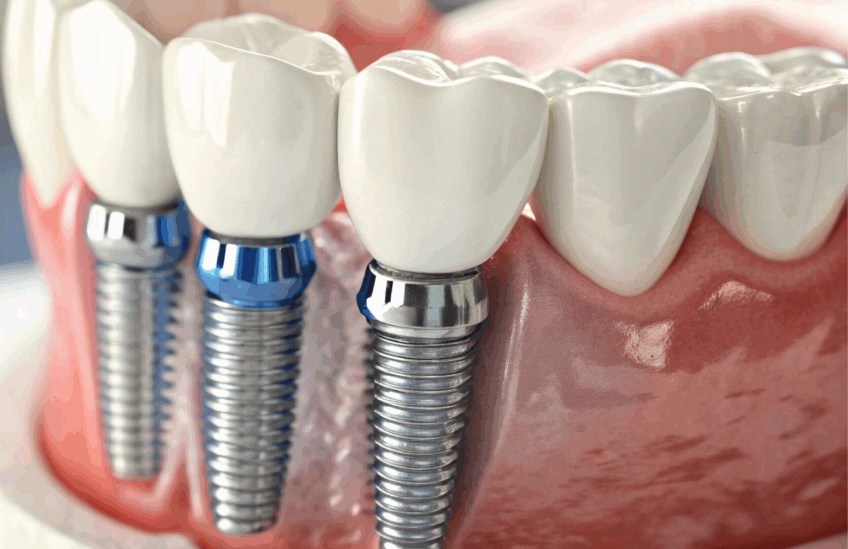 digital image of Prestige Dental Spa's dental implants.