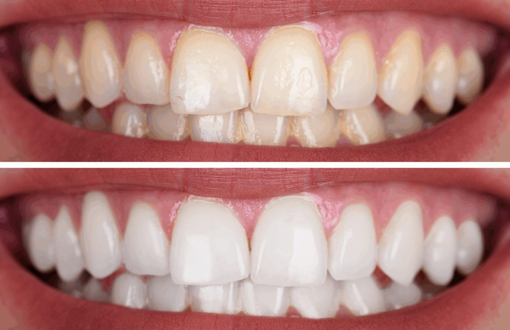 before and after image of a teeth after teeth whitening in Prestige Dental Spa in Lake Elsinore