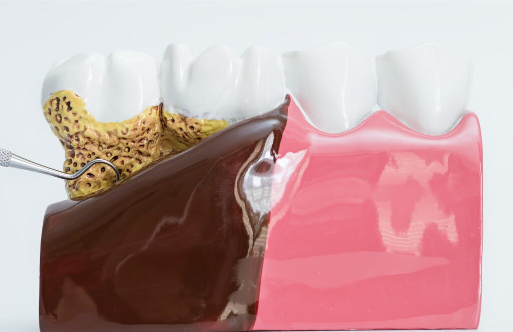 before and after digital image of a teeth under went to a periodontal treatment at Prestige Dental Spa in Lake Elsinore