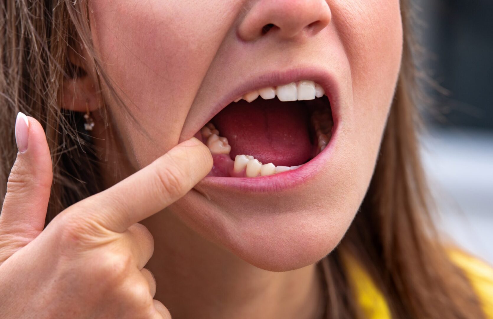 Helping you bring back confidence after treating missing teeth in Lake Elsinore in Prestige Dental Spa