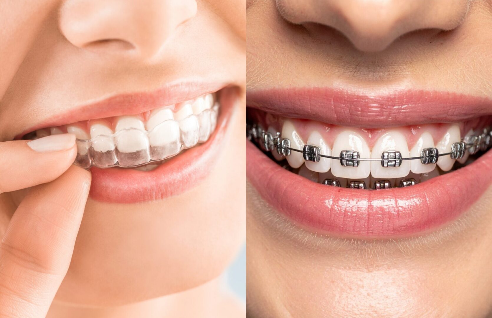 premium quality aligners and traditional braces at Lake Elsinore in Prestige Dental Spa