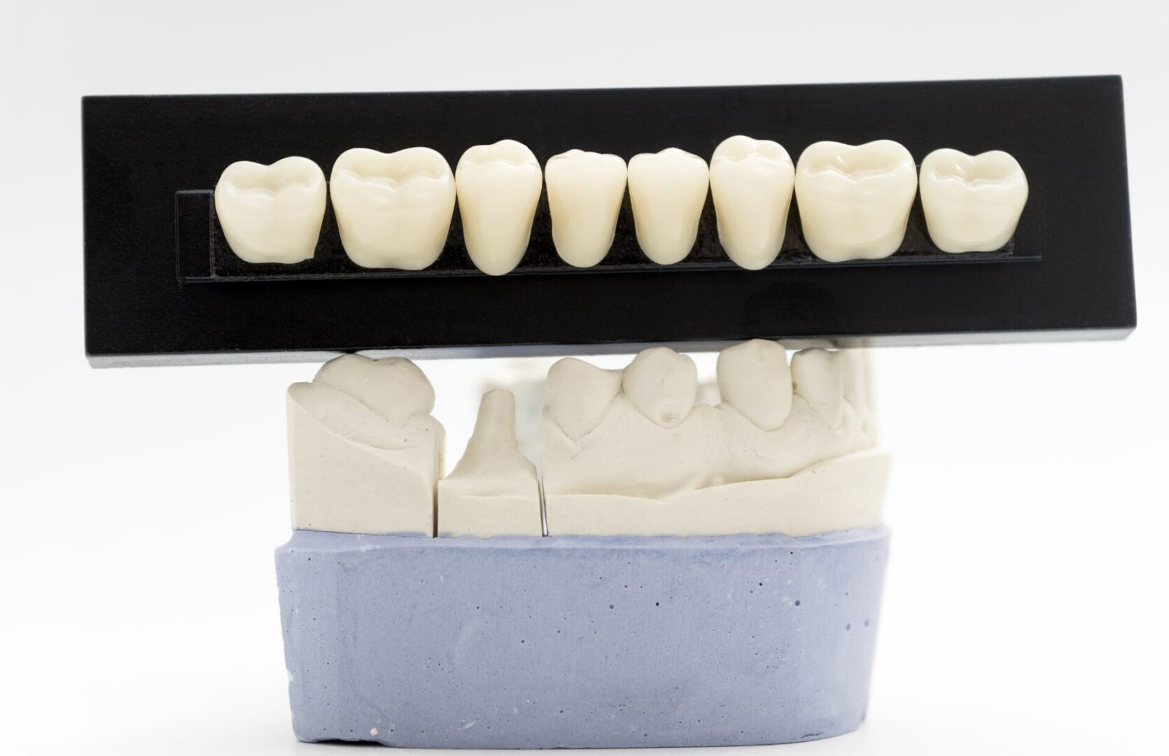 Dental Crown at Lake Elsinore in Prestige Dental Spa