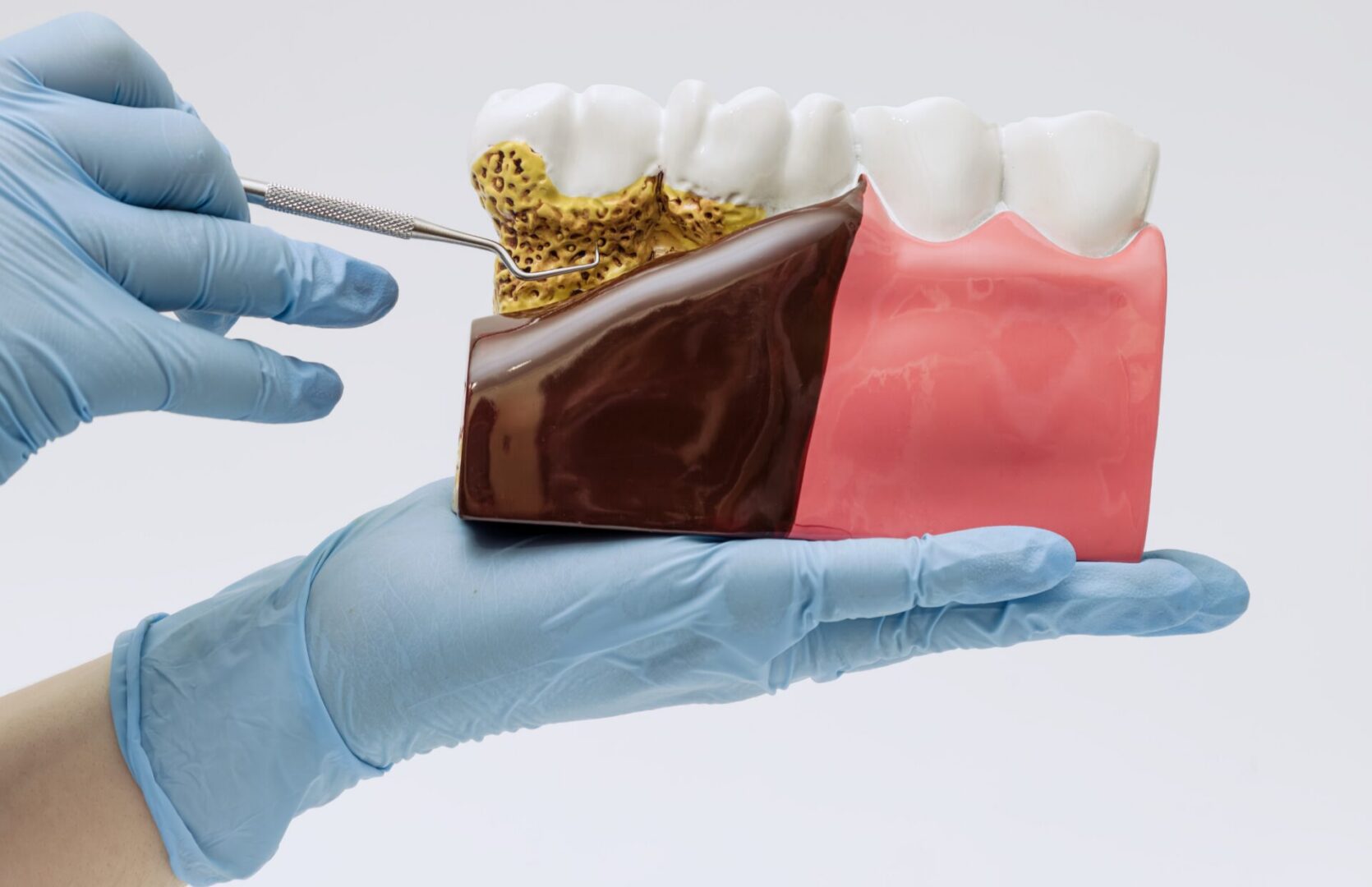 Dental Plaque And Gum Disease causing teeth sensitivity. Treatment at Lake Elsinore in Prestige Dental Spa